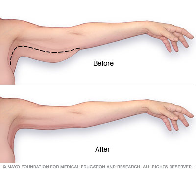Arm Lift Brachioplasty Mayo Clinic Health System