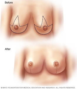 Breast lift or mastoplexy