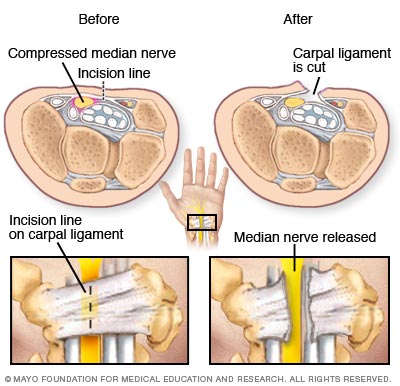 Carpal tunnel Syndrome