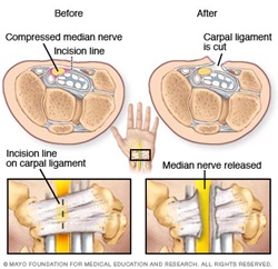 Carpal tunnel Syndrome