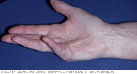 Dupuytren's contracture