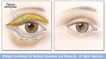 Eyelid Surgery
