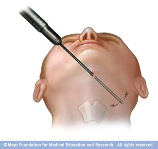 Liposuction