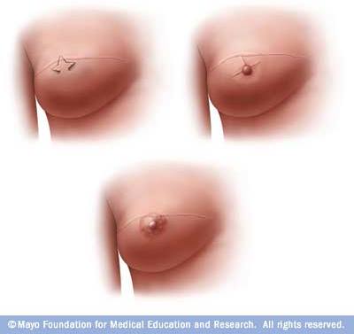 Nipple Reconstruction