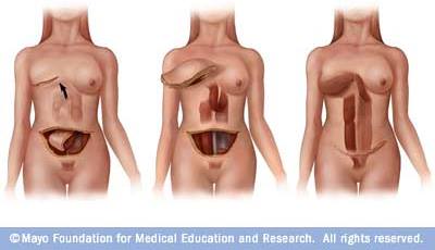 Pedicle Tram Flap