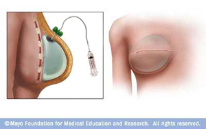 Breast tissue expansion