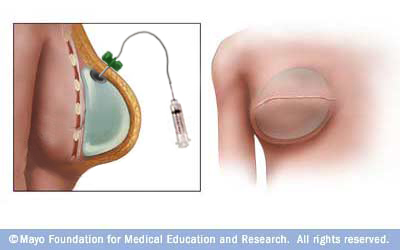 Tissue Expansion