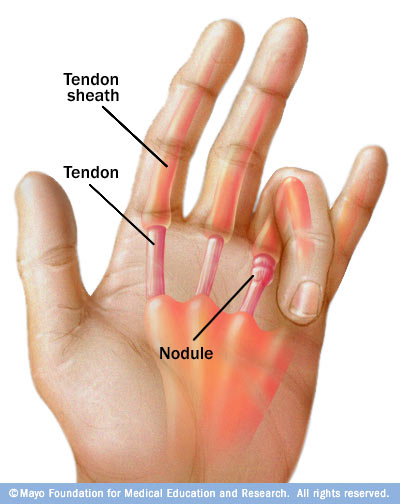 Trigger Hand Hand, Wrist, Elbow - Albert Lea - Mayo Clinic Health System