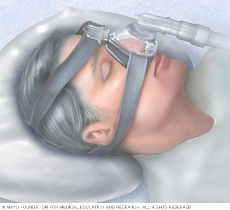 Continuous positive airway pressure (CPAP)