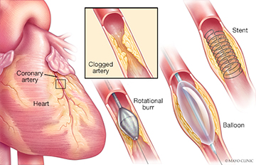 Illustration of angioplasty and stent placement