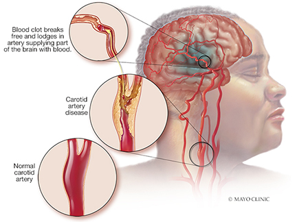 Illustration of Carotid Artery Disease