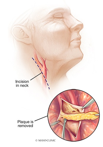 Carotid Endarterectomy