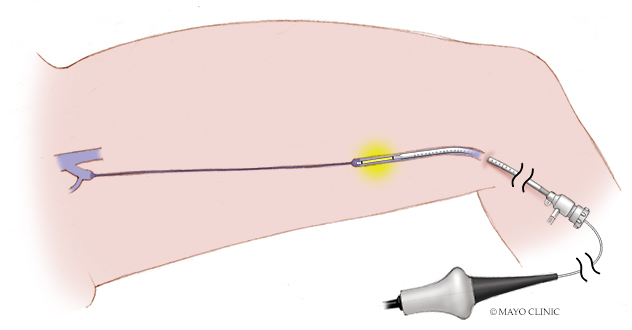 Illustration of Endovenous Laser Ablation Therapy