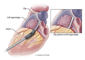Diagram of hybrid ablation