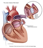 Diagram of Left Atrial Appendage Closure