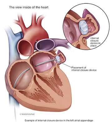 Diagram of Left Atrial Appendage Closure