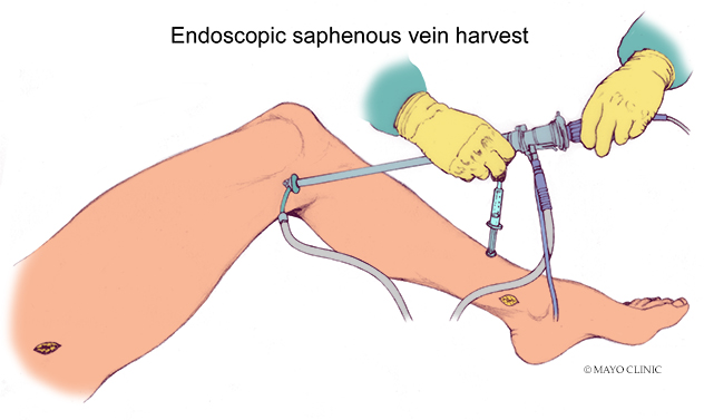 Diagram of minimally invasive vein harvest