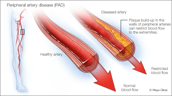 Illustration of Peripheral Artery Disease