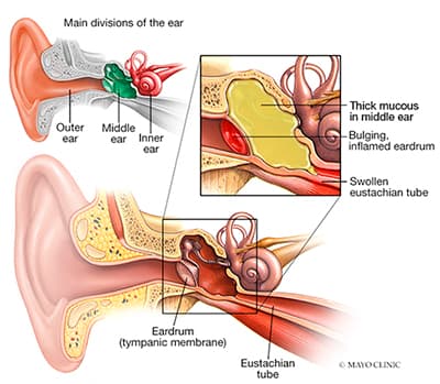 Diagram of the main divisions of the ear and what an ear infection looks like