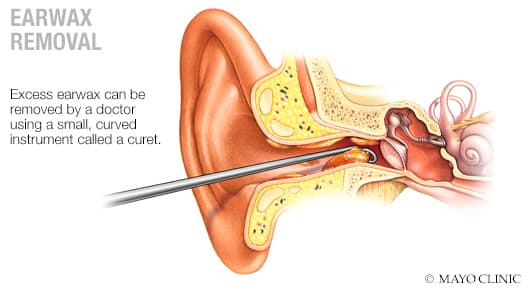 Ear Wax Removal Diagram