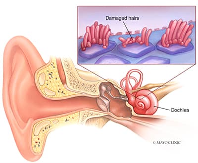 Hearing Loss Diagram