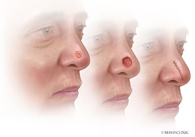 Mohs Surgery