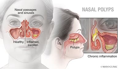 Nasal Polyps