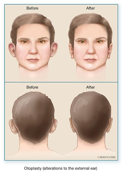 Otoplasty
