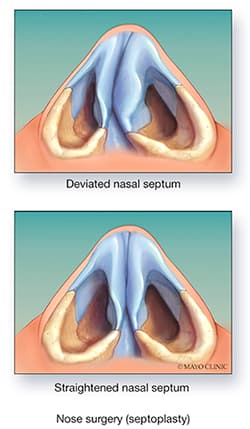 Septoplasty