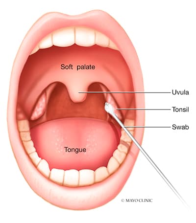 Tonsillitis - Tomah - Mayo Clinic Health System