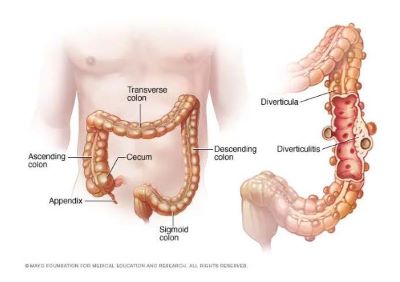 Diverticulitis