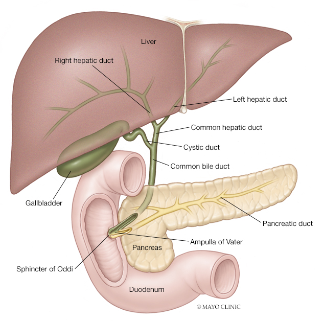 Gallstones