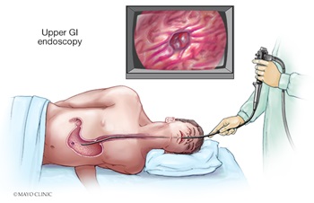 Upper GI endoscopy