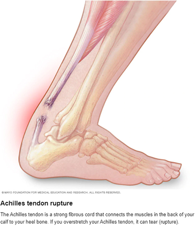 Achilles Tendon Rupture