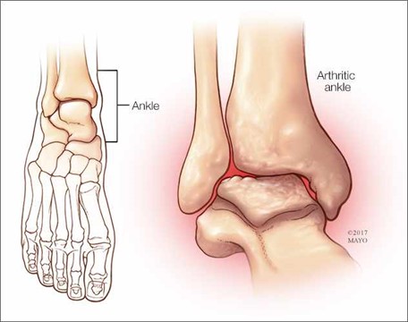 Diagram of ankle bones and ankle arthritis