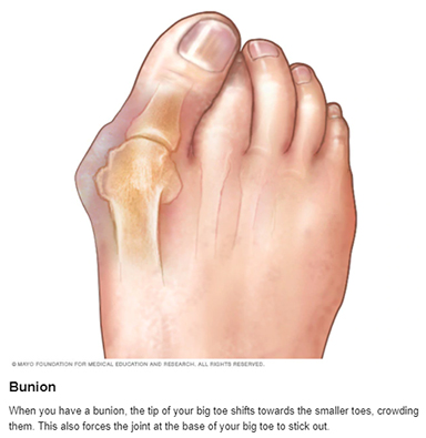 Bunion