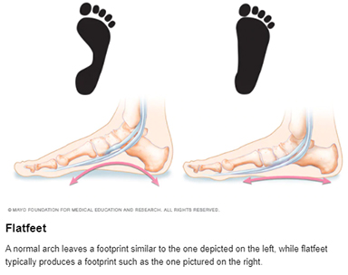 FlatFeet