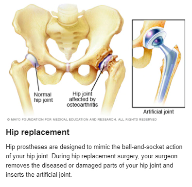 Knee Replacement