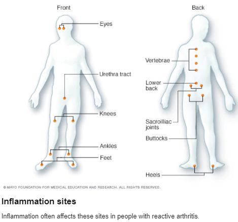 Inlamation Sites