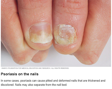 Psoriasis on the nails