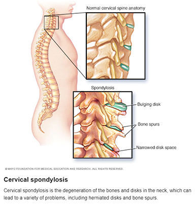 Cervical Sponylosis