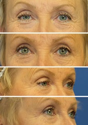 Eyelid lift before and after 1