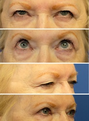 Eyelid lift before and after 2