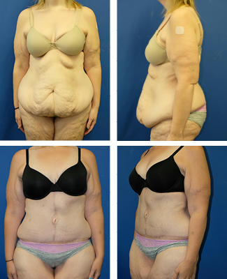 Lower abdomen before and after