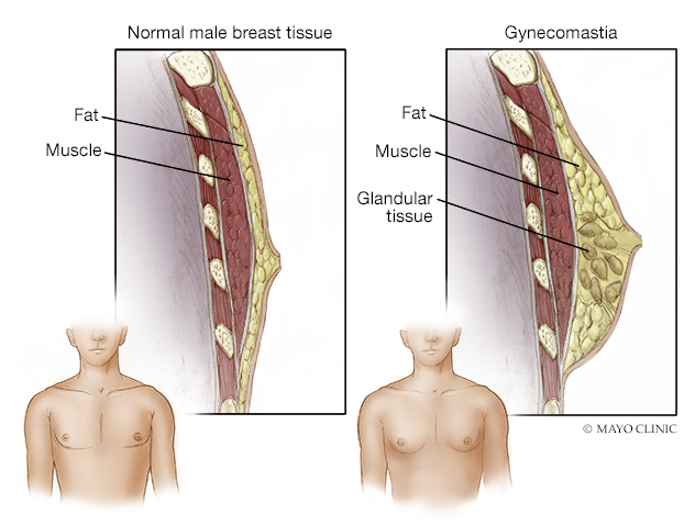 male breast reduction or gynecomastia