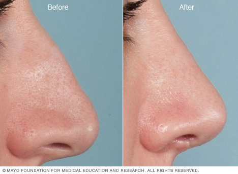 Rhinoplasty