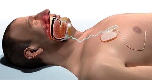 Upper airway stimulation illustration