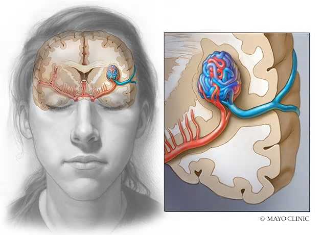 Brain arteriovenous malformation