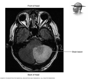 Brain lesion