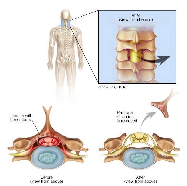 Cervical spondylosis in Mankato - Mayo Clinic Health System